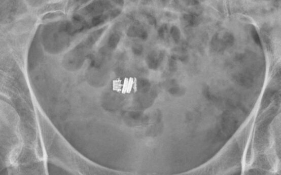 Radiografia dell'addome in cui si vede una videocapsula endoscopica ingerita, uno dei dispositivi medici che si possono inghiottire