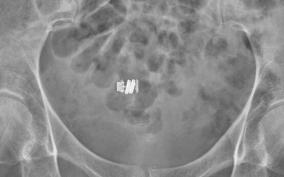 Radiografia dell'addome in cui si vede una videocapsula endoscopica ingerita, uno dei dispositivi medici che si possono inghiottire