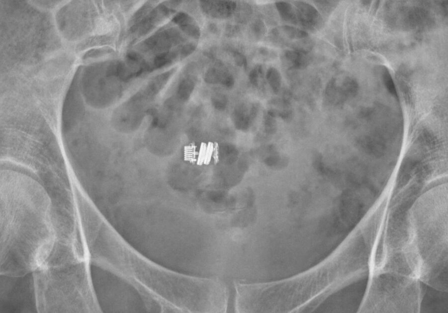 Radiografia dell'addome in cui si vede una videocapsula endoscopica ingerita, uno dei dispositivi medici che si possono inghiottire